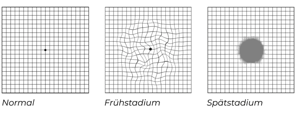 Quadrate mit Linien die den Amsler Selbsttest bei Makuladegeneration zeigen - vom AugenCentrum Hamburg