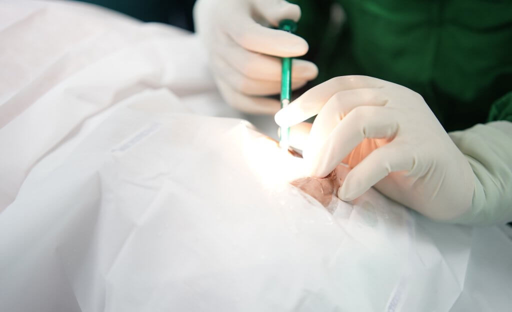 Linsenimplantation bei Katarakt